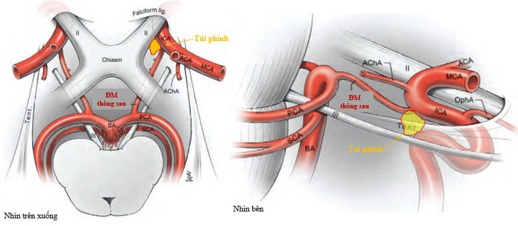 Nhiều người trẻ đột ngột vỡ mạch não